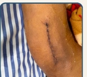 Stitchless cosmetic scar from DAA Hip replacement